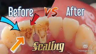 First Time Scaling |Tartar Removal| Male 23 y.o.| @dentist_ruli 23歳で初めて歯石を厚くスケーリング