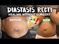 How I Healed Diastasis Recti NATURALLY