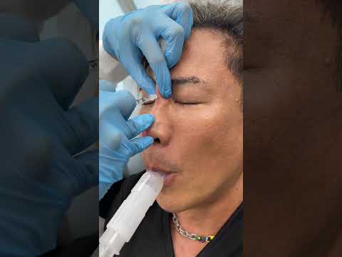 Nonsurgical Nosejob using Hylauronic Acid Fillers by Nurse Ami - Ageless MD