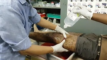 Open fracture emergency reduction femur in casualty, Adamya Hospital and Ortho Care Centre, videos