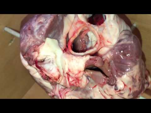 Video: Flux Perpendicular și Turbulent După înlocuirea Valvei Aortice: Scurgere Paravalvulară Sau Transvalvulară? Un Raport De Caz