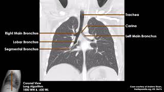 Airway & Lung Anatomy on CT Scans