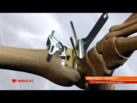 Wright Medical Prophecy Infinity Total Ankle Replacement