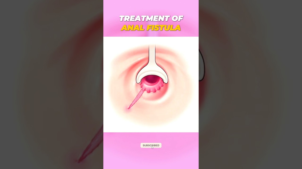 Лечение анального свища | Медицинская 3D-анимация | Объяснение хирургии и процедур 