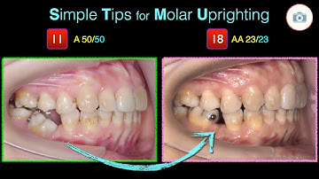 Simple Tips for Molar Uprighting｜【Chris Chang Ortho】CC674