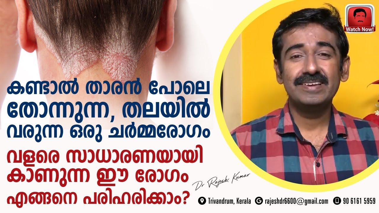 താരൻ പോലെ തോന്നുന്ന തലയിൽ വരുന്ന ഒരു ചർമ്മരോഗം.. സാധാരണയായി കാണുന്ന ഈ അവസ്ഥ എന്ന് പരിഹരിക്കാം ?