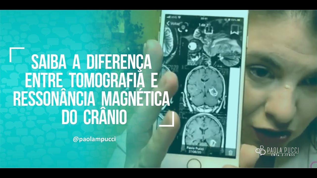 Saiba a diferença entre tomografia e ressonância magnética do crânio ...