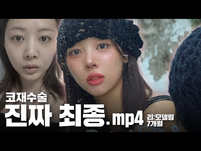 리;모델링 ㅣ "이제 나무늘보 탈출했어요!" 용코 구축 재수술+윤곽 7개월 후기 ㅣ 비티성형외과