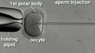 IVF & ICSI brief overview