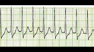 Adenosine Setup Administration Part 22