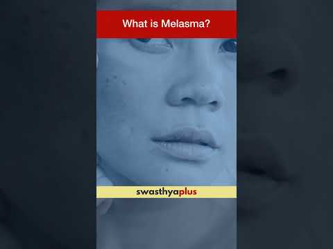 What is Melasma? | Facial Pigmentation | Dr Soumya Kanti Datta | #Shorts