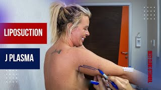 From Ireland to Istanbul 🇮🇪✨ | #liposuction  &amp; #j-plasma Experience at Best Clinic Istanbul