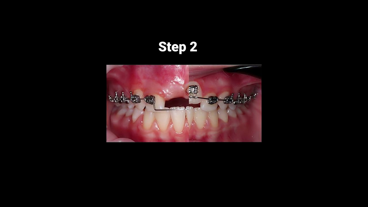 How Do Braces Work 