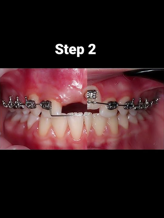 How do braces work?