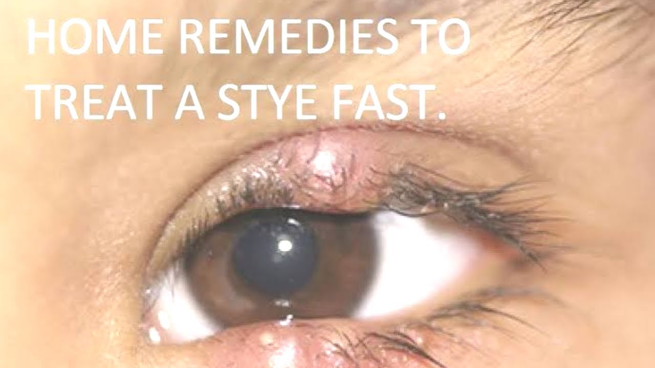 How To Get Rid Of A Stye Remedies and Treatment! Want To Get Rid Of