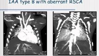 Interrupted aortic arch