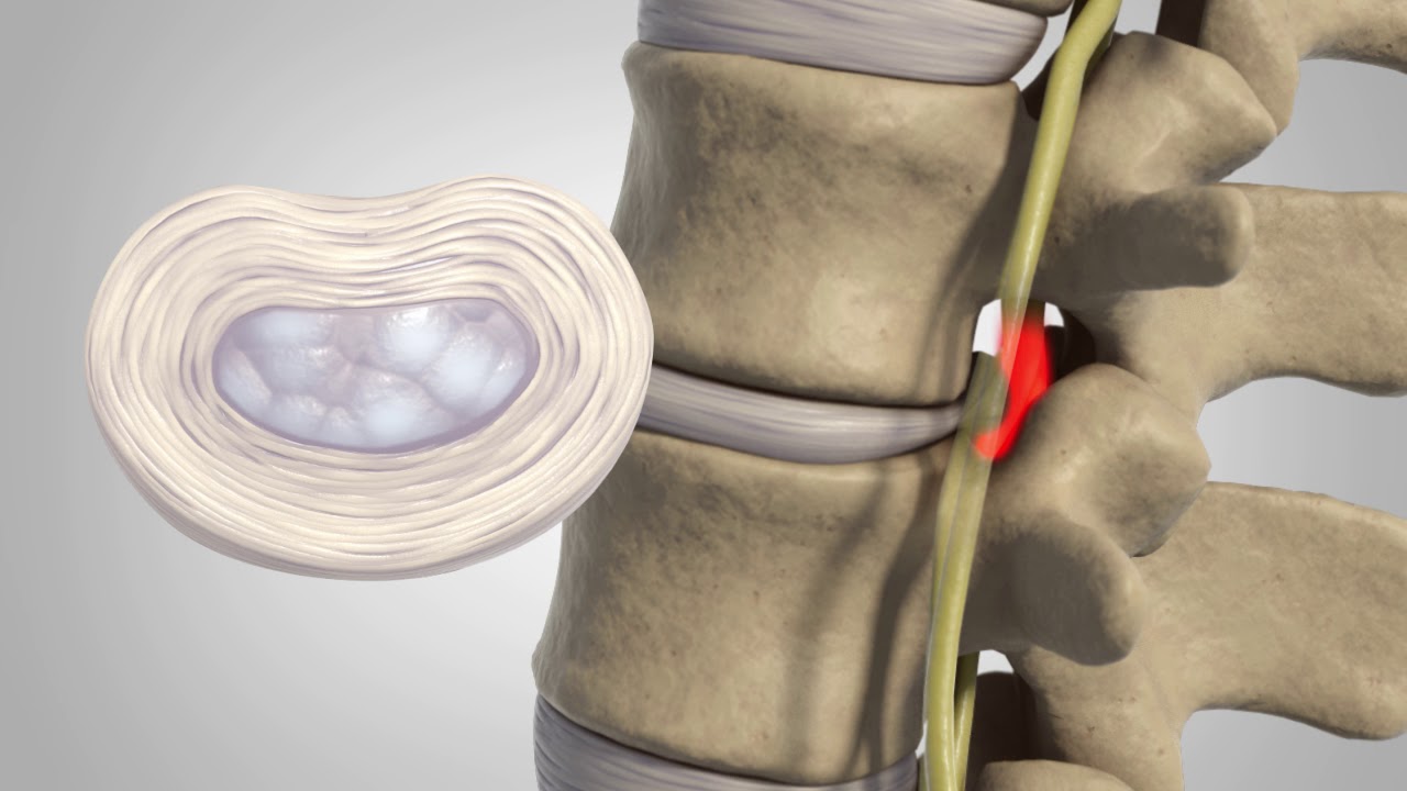 Common Symptoms of Degenerative Disc Disease - Hernando Orthopedic & Spinal  Surgery Spring Hill, Florida