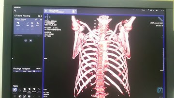 How to Bone MM reading in Syngo.via