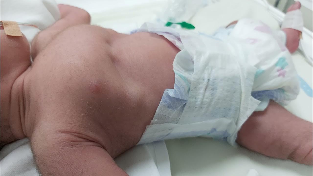 Severe RDS, chest retraction, chest bulge ,respiratory failure