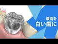 セラミッククラウンを使って白くてキレイな歯の仕上がりに!! White Tooth With Ceramic Crown!