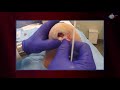 WCW: Removal of Exposed Bone in a Diabetic Foot Ulcer