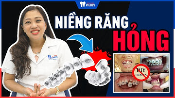 Niềng răng hỏng - Dấu hiệu nhận biết và cách khắc phục