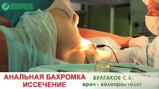 Анальная бахромка осложненная тромбозом. Как удаляют? Проктологическая операция в клинике Наука. Анальная бахромка осложненная тромбозом. Как удаляют? Проктологическая операция в клинике Наука.