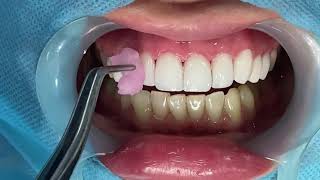 Veneers cementation & gum conditioning.