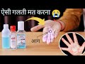 Hand Sanitizer से हाथ जल गया - इसलिए लगाने से पहले विडियो देखलो || Is Hand Sanitizer safe To Use