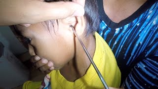 Something STUCK in Boy's Ear for Days Removed | He Gets SHOCKED! by Earwax Specialist 15,403 views 2 months ago 54 seconds