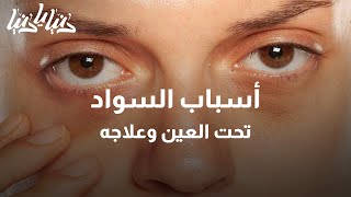 أسباب السواد تحت العين وعلاجه - دنيا يا دنيا سواد_العيون