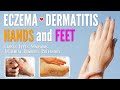 Eczema on Hands and Feet Causes, Symptoms, Types, Treatment, Remedies, Prevention | Dermatitis treat