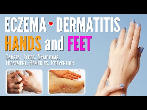 Video: Weeping Eczema On Hands And Feet - Causes, Symptoms And Treatment