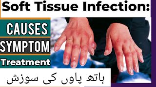 What is soft tissue infection, causes, sign and symptoms, Treatment of soft tissue infection. screenshot 5