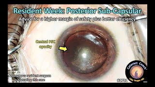 CataractCoach™1781: resident week: posterior sub-capsular (PSC) cataract