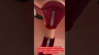 "IUD Insertion Explained | Safe Birth Control Method (Educational 3D Animation)" #healtheducation