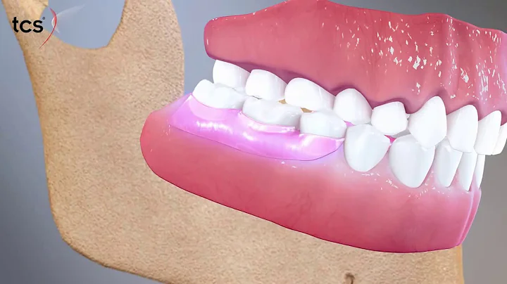 Flexible Partial Dentures Animation