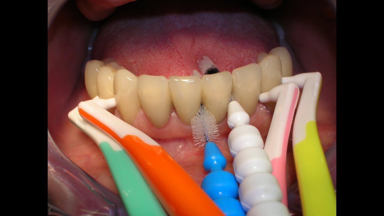 CEPILLOS INTERDENTALES o "Interprox"* YouTube