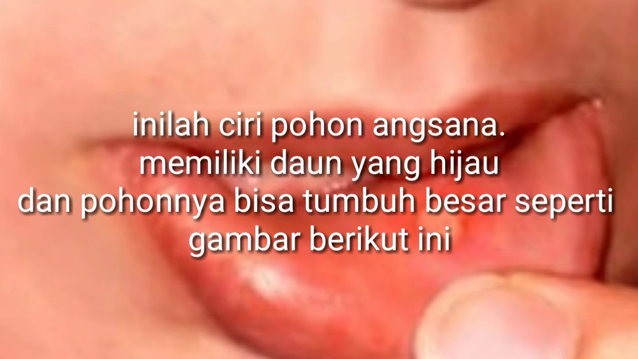 Cara mengobati sariawan tradisional