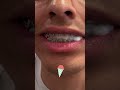 Snow Vs. Braces 🥶