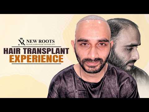 2 Session Hair Transplant Surgery (5500 Grafts) 🤯 | Hair Transplant in Raipur | New Roots