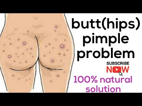 Butt (hips)acne/pimple removal homeremedy| Hips এর ফোঁড়া বা ফুশকরি এর ঘরোয়া উপায়| ayurvedic nushke |