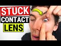 How to Remove a STUCK Contact Lens from the Eye