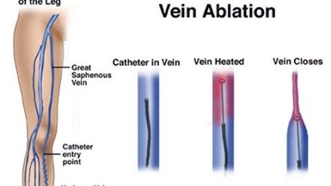 Endovenous ablation therapy CPT code - simplify medical coding