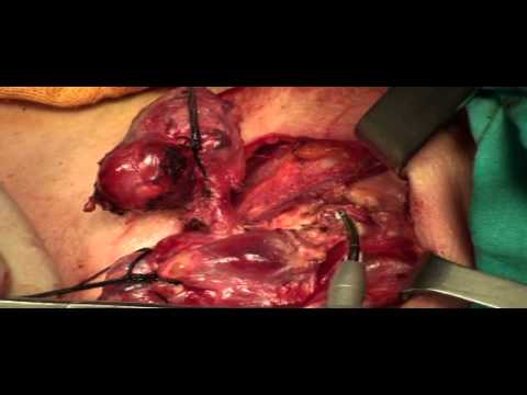 Canlı Yayın - Tiroid Kanserinde Boyun Diseksiyonu Kursu - 14 Haziran 2013
