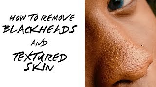 If you are starting to notice your nose looking like a strawberry some
of these at home remedies can help smooth and get rid those clogged
pores...