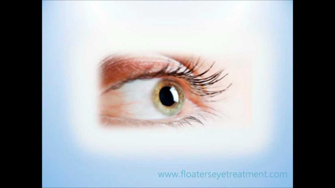 Floters In Eye Causes Of Eye Floaters YouTube