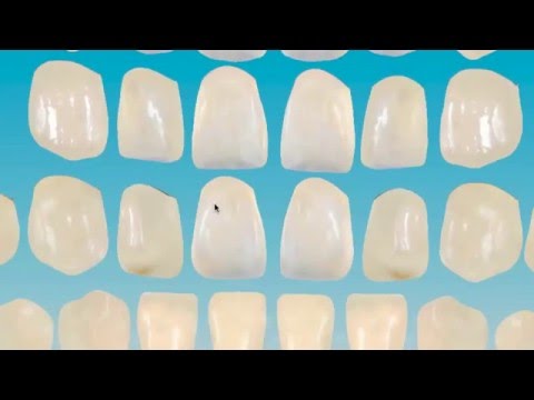 Digital Teeth Library With Texture. Free Software, Face Integration For Wax-ups