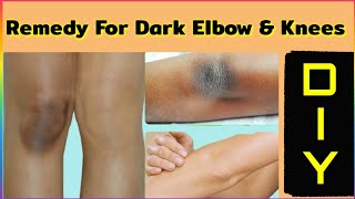 Diy Remedy For Dark Elbow Knees మకళళ మచతల నలప నడ తలప క వచచ మచ చటక....