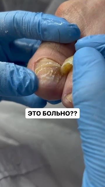 Это больно? Отслоился ноготь/пустота под ногтем - YouTube